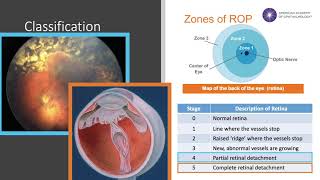 Retinopathy of Prematurity [upl. by Calesta]