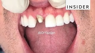 How Dentists Create Tooth Veneers And Crowns [upl. by Fessuoy]