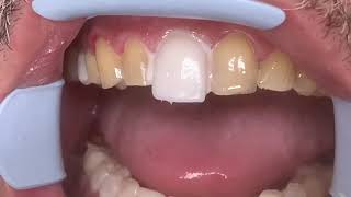 Houston Cosmetic DentistStep by step procedure for Porcelain VeneersConservative preps [upl. by Denten]