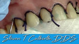 Impression Cord Placement for Veneers  Dental Minute with Steven T Cutbirth DDS [upl. by Eibrad418]