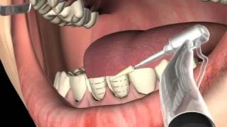 What are Dental Veneers [upl. by Leggett240]