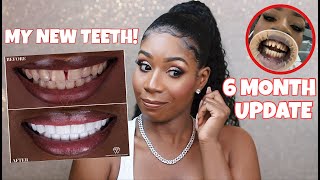 DO I REGRET GETTING VENEERS IN TURKEY THE TRUTH  6 Month Update QampA [upl. by Abih]