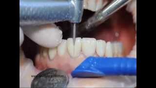 Procera veneers removal [upl. by Aniv269]