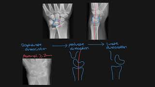 Carpal bone fractures [upl. by Docia189]