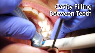 Dentist Filling A Cavity Between Teeth [upl. by Calie]