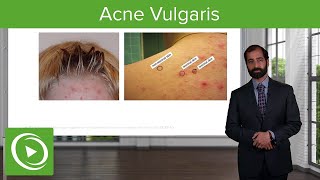 Inflammatory Skin Diseases Acne Vulgaris – Pathology  Lecturio [upl. by Cass]