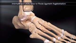 InternalBrace™ ATFL Talus to Fibula Ligament Augmentation [upl. by Usanis175]