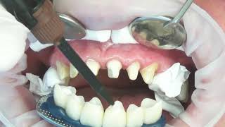 Procedure of Placing Dental Veneers Hollywood smile [upl. by Jablon]