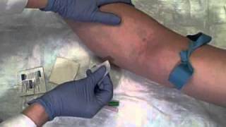 Phlebotomy on Live Patient Straight Needle [upl. by Hadria279]