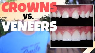 Dental CROWNS vs Porcelain VENEERS  Is the Dental Veneers Procedure Worth It [upl. by Yatzeck281]