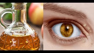 Natural Remedies to Cure Xanthelasma or Cholesterol Deposits Around the Eyes [upl. by Edvard]