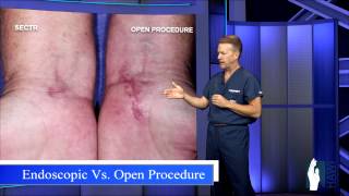 Carpal Tunnel Release  Open Procedure vs Endoscopic [upl. by Kester]