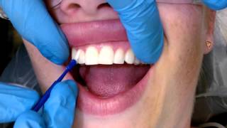 Tips For Applying Fluoride Varnish [upl. by Tdnarb570]