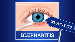 Blepharitis red swollen eyelids Causes Symptoms Treatments [upl. by Stulin]