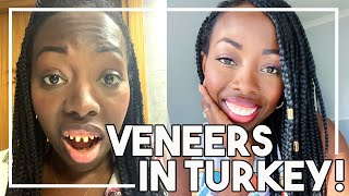 Getting Veneers in Turkey THE TRUTH  Dental Center Turkey [upl. by Rodriguez]