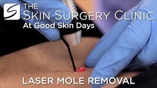 Laser Mole Removal  Watch the Procedure [upl. by Edaw]