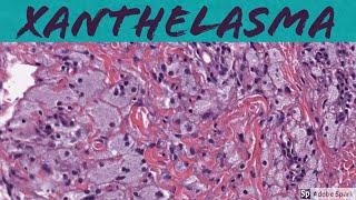 Xanthelasma Xanthoma of Eyelid 5Minute Pathology Pearls [upl. by Shel368]