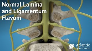 Normal Lamina and Ligamentum Flavum [upl. by Sivam]