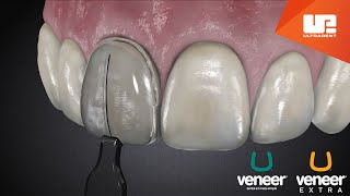 Uveneer® Procedure Animation  Direct Veneer Template System [upl. by Ahseym]