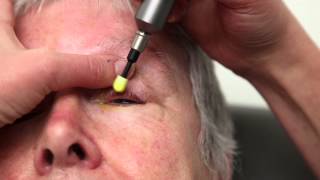 Blepharitis Treatment That Really Works Blephex Eyelid Cleaning [upl. by Kcirdahc]