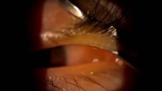 Meibomian gland expression  Unblocking extremely blocked oil glands in the eyelid [upl. by Aillicirp]