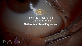 Meibomian Gland Expression [upl. by Ainegue503]