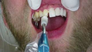 Veneers Dental Procedure at Cosmetic Dental Associates in San Antonio TX [upl. by Laurentium]